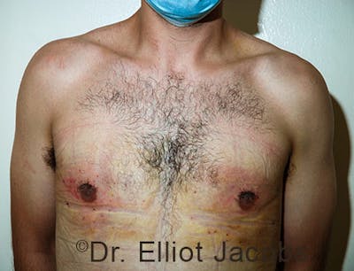 Crater Deformities Before & After Gallery - Patient 120163431 - Image 4