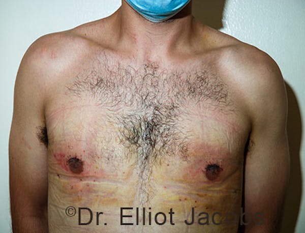Crater Deformities Before & After Gallery - Patient 120163431 - Image 4