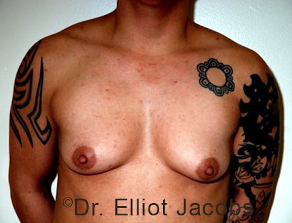 FTM Top Surgery Before & After Gallery - Patient 120163469 - Image 1