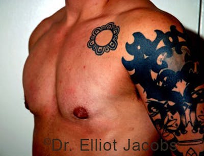 FTM Top Surgery Before & After Gallery - Patient 120163469 - Image 4