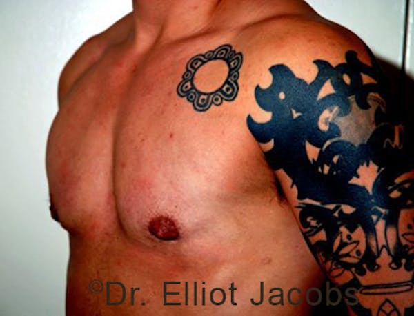 FTM Top Surgery Before & After Gallery - Patient 120163469 - Image 4
