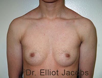 FTM Top Surgery Before & After Gallery - Patient 120163470 - Image 1