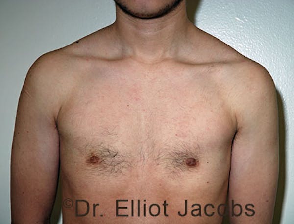 FTM Top Surgery Before & After Gallery - Patient 120163470 - Image 2