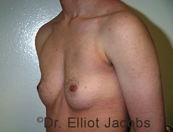 FTM Top Surgery Before & After Gallery - Patient 120163470 - Image 3