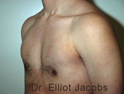 FTM Top Surgery Before & After Gallery - Patient 120163470 - Image 4