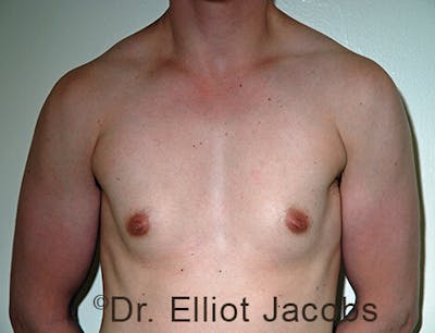 FTM Top Surgery Before & After Gallery - Patient 120163471 - Image 1