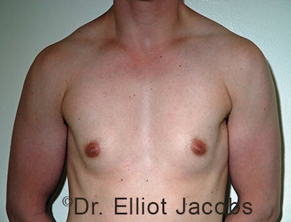FTM Top Surgery Before & After Gallery - Patient 120163471 - Image 1