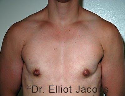 FTM Top Surgery Before & After Gallery - Patient 120163471 - Image 2