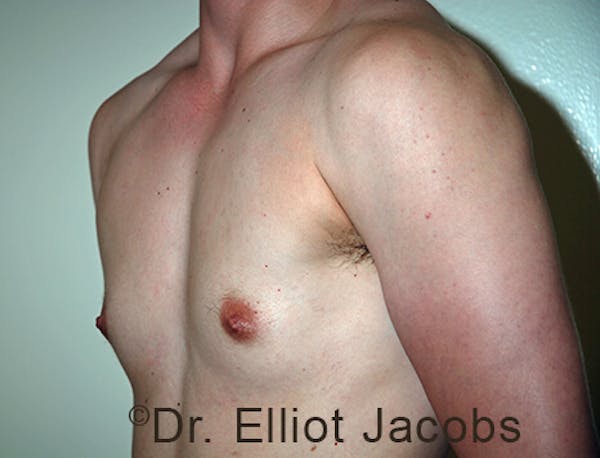 FTM Top Surgery Before & After Gallery - Patient 120163471 - Image 3