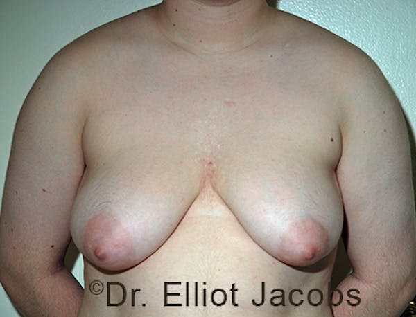 FTM Top Surgery Before & After Gallery - Patient 120163472 - Image 1