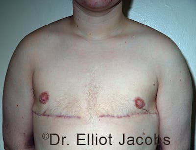 FTM Top Surgery Before & After Gallery - Patient 120163472 - Image 2