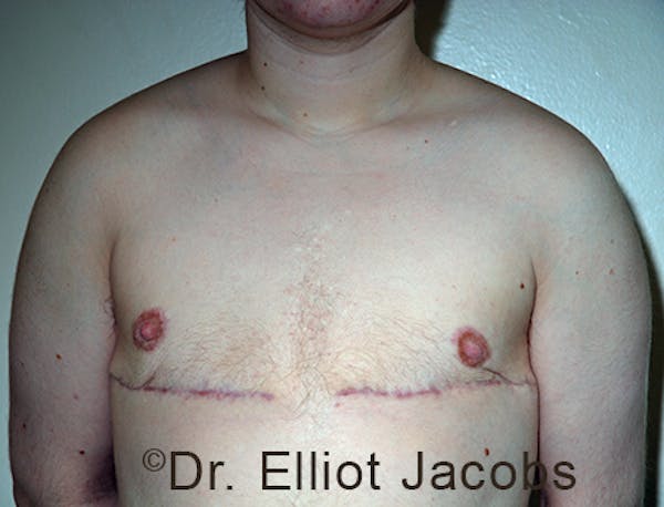 FTM Top Surgery Before & After Gallery - Patient 120163472 - Image 2