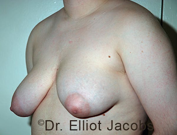FTM Top Surgery Before & After Gallery - Patient 120163472 - Image 3