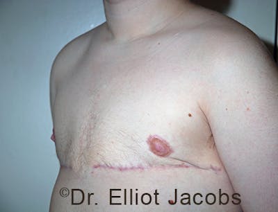 FTM Top Surgery Before & After Gallery - Patient 120163472 - Image 4