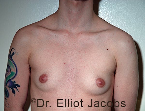 FTM Top Surgery Before & After Gallery - Patient 120163473 - Image 1