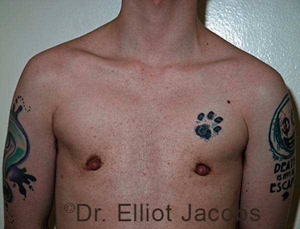 FTM Top Surgery Before & After Gallery - Patient 120163473 - Image 2