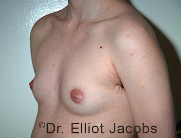 FTM Top Surgery Before & After Gallery - Patient 120163473 - Image 3