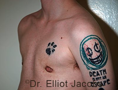 FTM Top Surgery Before & After Gallery - Patient 120163473 - Image 4