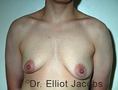 FTM Top Surgery Before & After Gallery - Patient 120163474 - Image 1