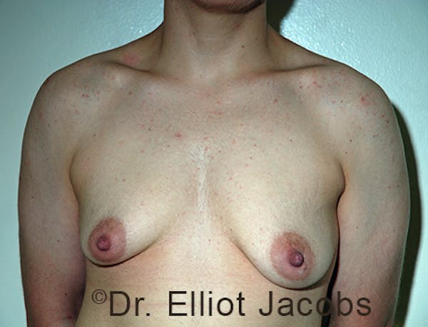 FTM Top Surgery Before & After Gallery - Patient 120163474 - Image 1