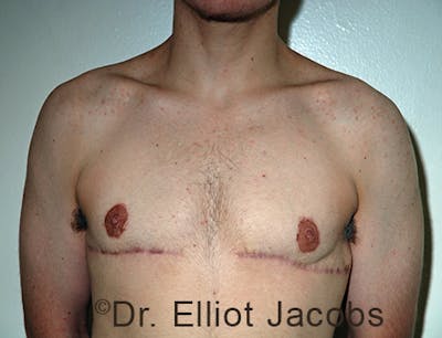 FTM Top Surgery Before & After Gallery - Patient 120163474 - Image 2
