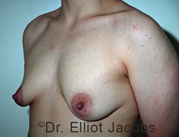 FTM Top Surgery Before & After Gallery - Patient 120163474 - Image 3