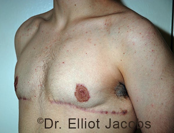 FTM Top Surgery Before & After Gallery - Patient 120163474 - Image 4
