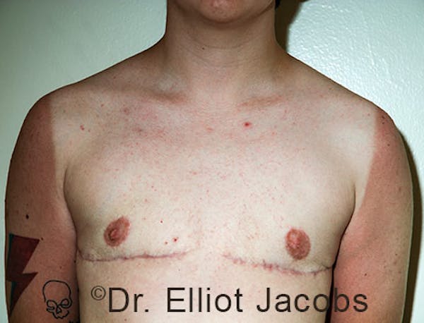 FTM Top Surgery Before & After Gallery - Patient 120163475 - Image 2