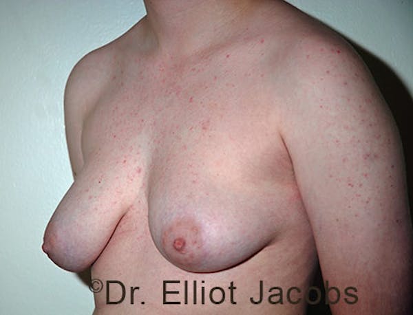 FTM Top Surgery Before & After Gallery - Patient 120163475 - Image 3