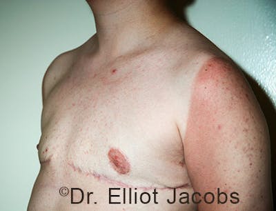 FTM Top Surgery Before & After Gallery - Patient 120163475 - Image 4