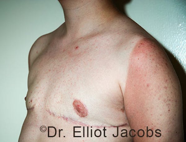 FTM Top Surgery Before & After Gallery - Patient 120163475 - Image 4