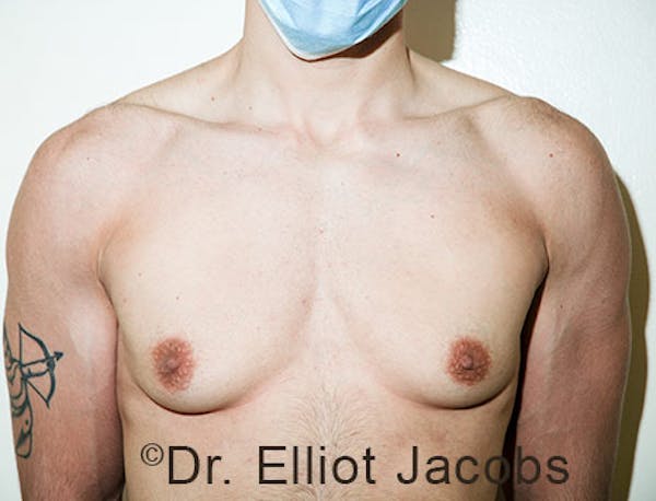 FTM Top Surgery Before & After Gallery - Patient 120163476 - Image 1