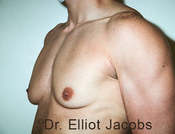 FTM Top Surgery Before & After Gallery - Patient 120163476 - Image 3
