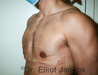 FTM Top Surgery Before & After Gallery - Patient 120163476 - Image 4