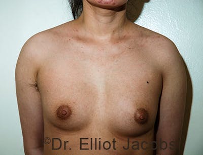FTM Top Surgery Before & After Gallery - Patient 120163477 - Image 1