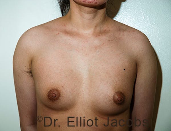 FTM Top Surgery Before & After Gallery - Patient 120163477 - Image 1