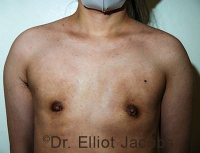 FTM Top Surgery Before & After Gallery - Patient 120163477 - Image 2