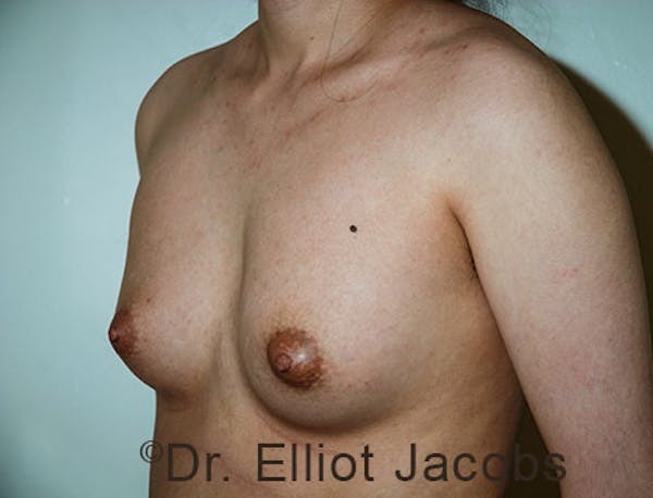 FTM Top Surgery Before & After Gallery - Patient 120163477 - Image 3