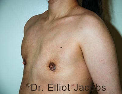 FTM Top Surgery Before & After Gallery - Patient 120163477 - Image 4