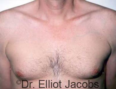 Gynecomastia Before & After Gallery - Patient 120163522 - Image 1