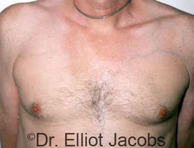 Gynecomastia Before & After Gallery - Patient 120163522 - Image 2