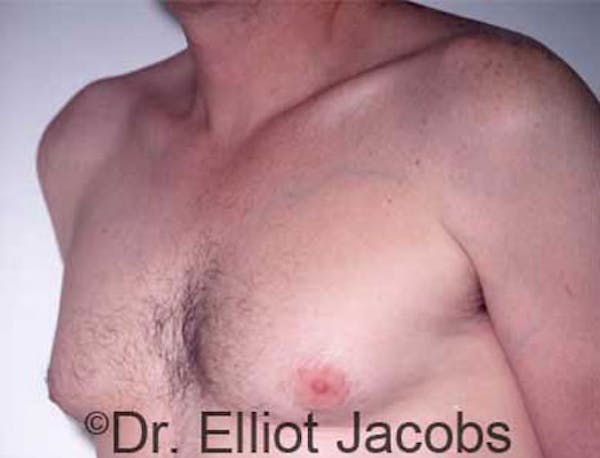 Gynecomastia Before & After Gallery - Patient 120163522 - Image 3