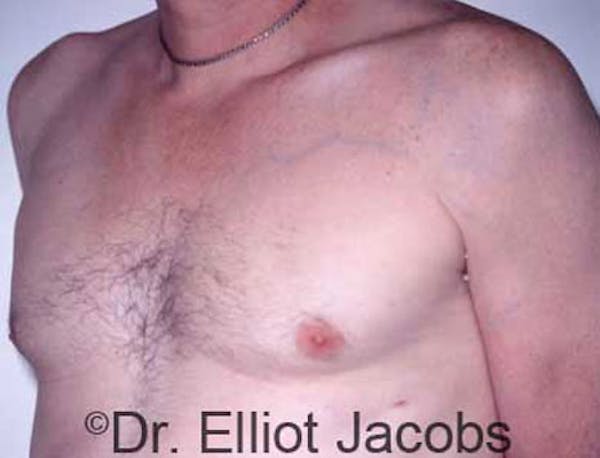 Gynecomastia Before & After Gallery - Patient 120163522 - Image 4