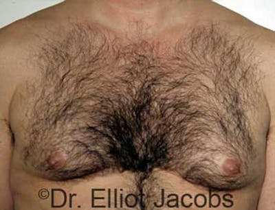 Gynecomastia Before & After Gallery - Patient 120163523 - Image 1