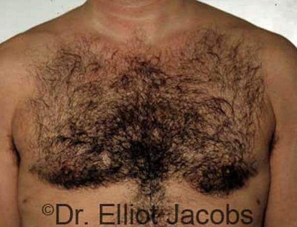 Gynecomastia Before & After Gallery - Patient 120163523 - Image 2