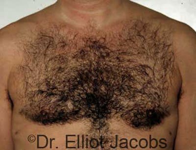Gynecomastia Before & After Gallery - Patient 120163523 - Image 2