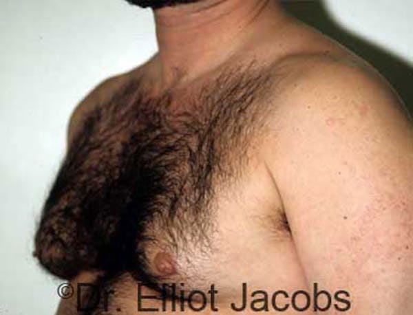 Gynecomastia Before & After Gallery - Patient 120163523 - Image 3