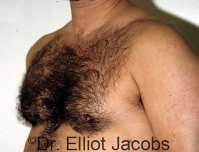 Gynecomastia Before & After Gallery - Patient 120163523 - Image 4