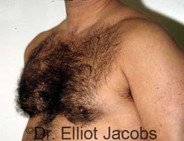 Gynecomastia Before & After Gallery - Patient 120163523 - Image 4