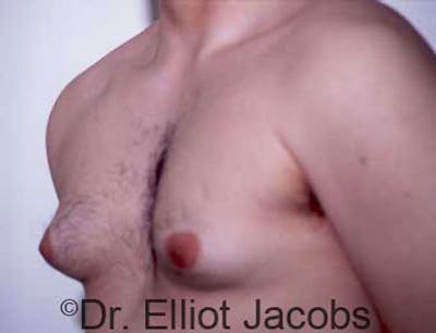 Gynecomastia Before & After Gallery - Patient 120163524 - Image 1
